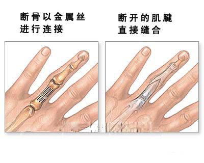 断指再植