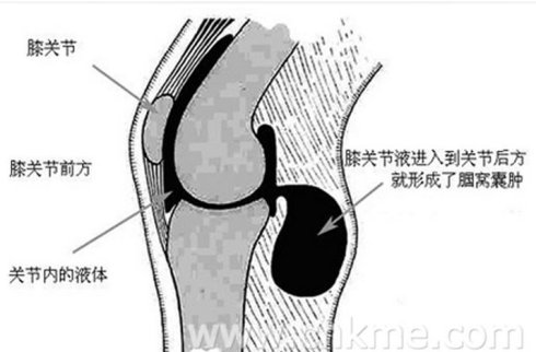 滑膜炎是一种多发性疾病,其发病部位主要在膝关节.