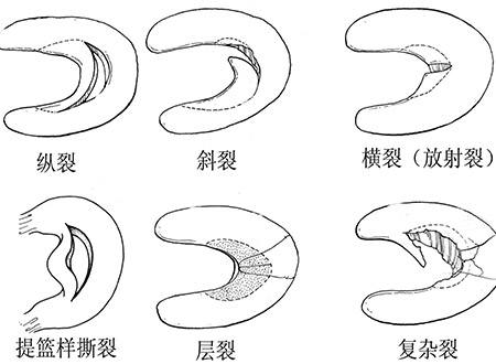 半月板损伤常见病因