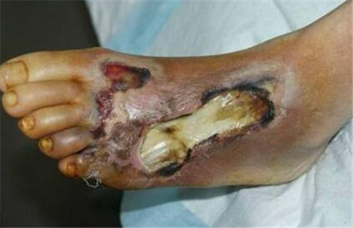 溃疡,坏疽发病部位:足部根据糖尿病足部病变的性质,可分为湿性坏疽
