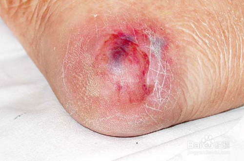 压疮的预防及护理